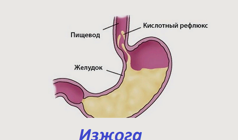 Киселинен рефлукс - киселини: Симптоми. Какви продукти не могат да ядат с киселинен рефлукс: списък, съвети, препоръки