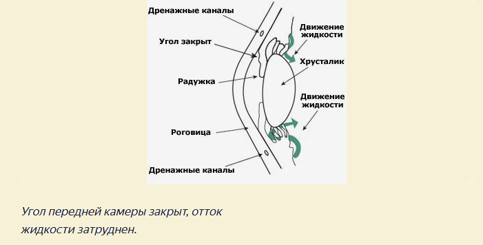 Затваряне на формата на глаукома