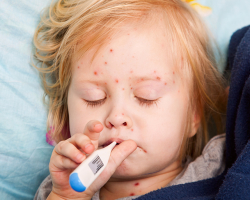 Ošpice pri otrocih: prvi znaki, simptomi, diagnoza, zdravljenje, zapleti, posledice, preprečevanje, cepljenje. Kako se manifestira ošpice, kako izgleda izpuščaj pri otrocih?