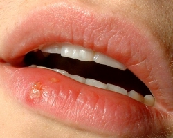 Herpes on the lips during pregnancy: danger, consequences, treatment. Causes of herpes on the lips of 1, 2 and 3 trimester of pregnancy