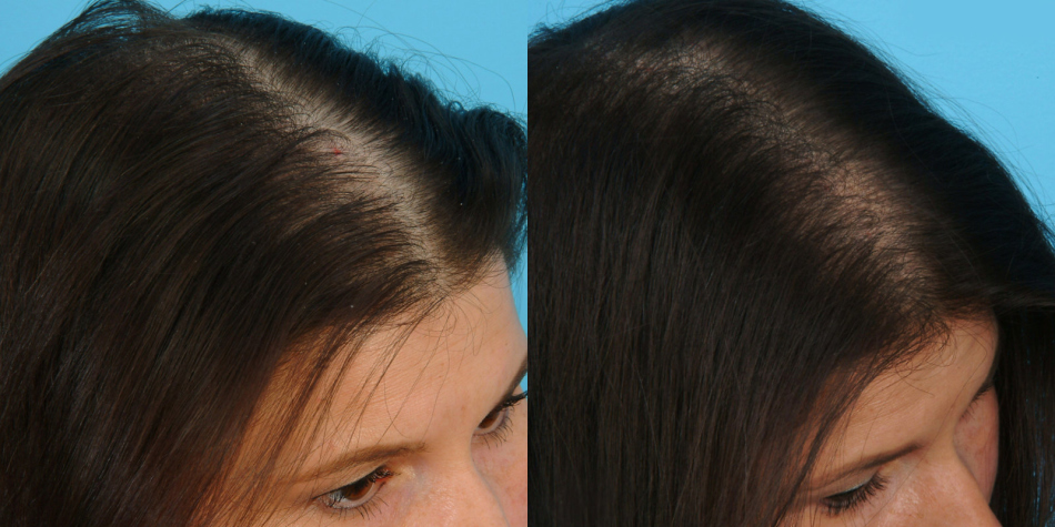 The effect of baldness treatment with hormonal injections