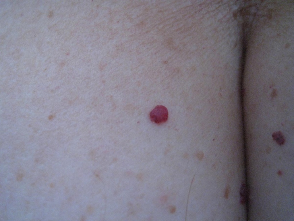 angioma