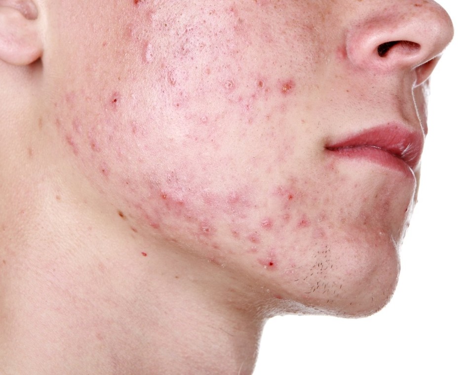 Acne with golden staphylococcus