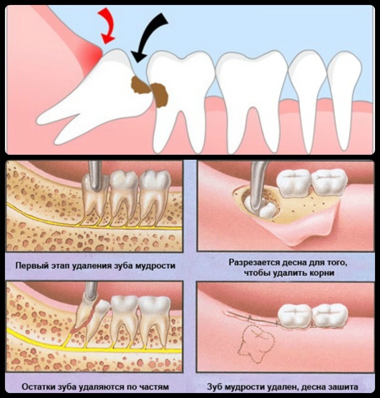 The process of removing wisdom tooths