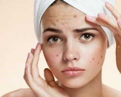 Why is it impossible to squeeze acne on the face, how then to get rid of them? If you do not crush acne, will they disappear themselves, where the pus will go? What to do if the pimple was squeezed out on the face? How to stop crushing acne on your face: Tips
