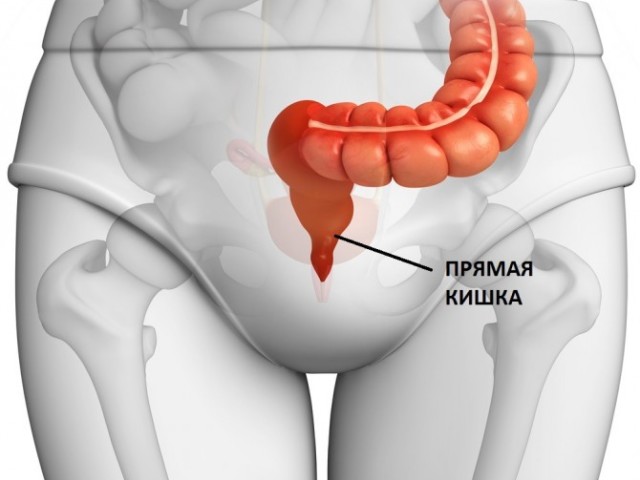 Cancer du rectum: symptômes et causes, étapes, diagnostic, traitement, prévisions