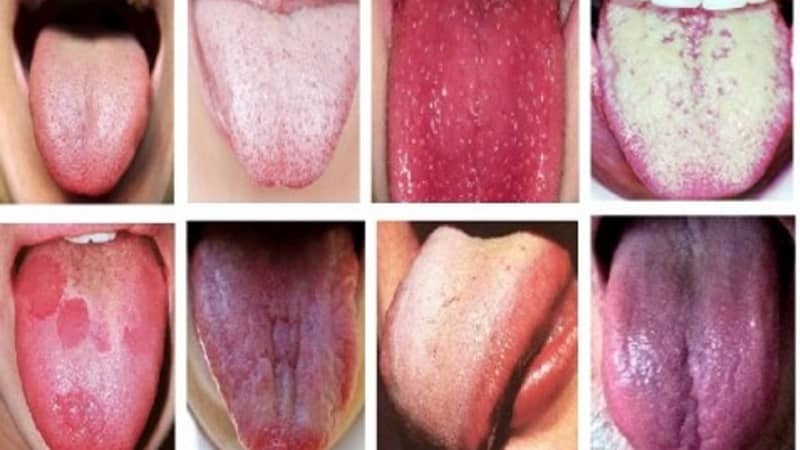 Plaque colors in the tongue