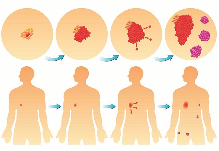 Stages of cancer development