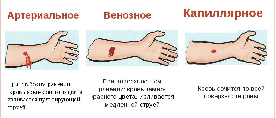 Важно отличать кровотечения по видам