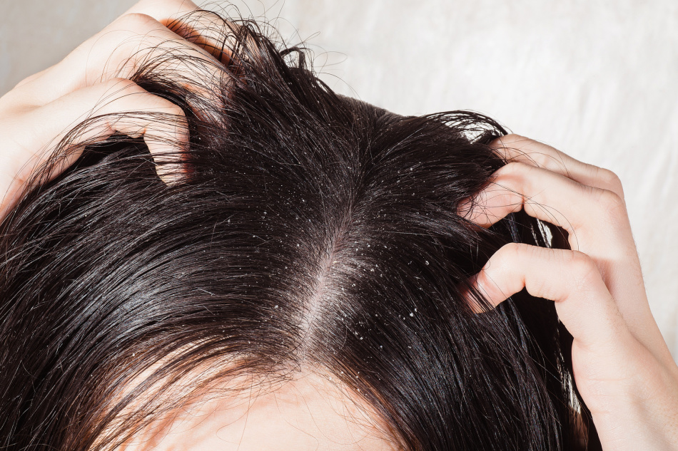 How to get rid of dandruff with soda?