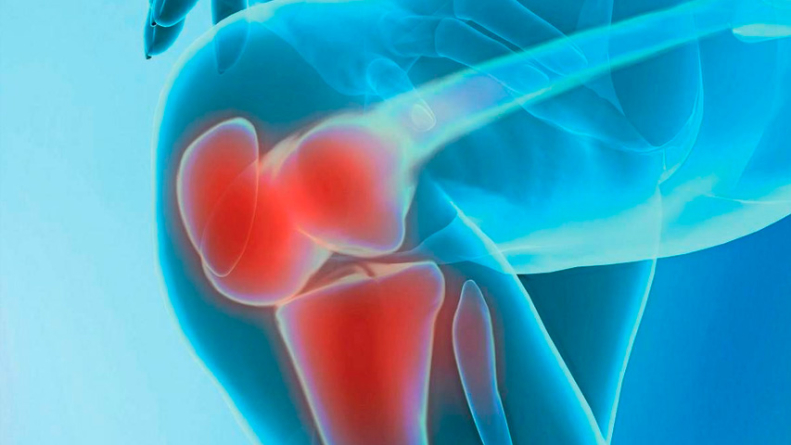 Omega-3 reduziert die Schmerzen und Schwellung der Gelenke mit Arthritis.
