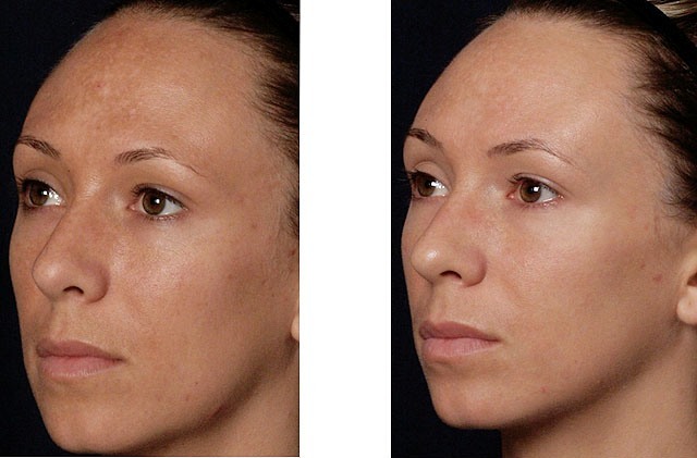 The result after the month of the use of hyaluronic acid