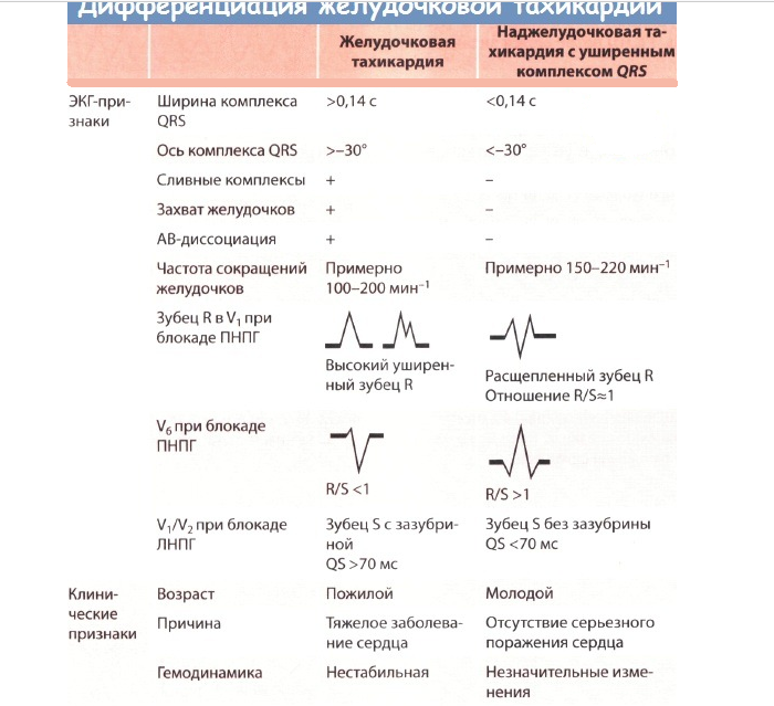 Differentiation of ventricular tachycardia