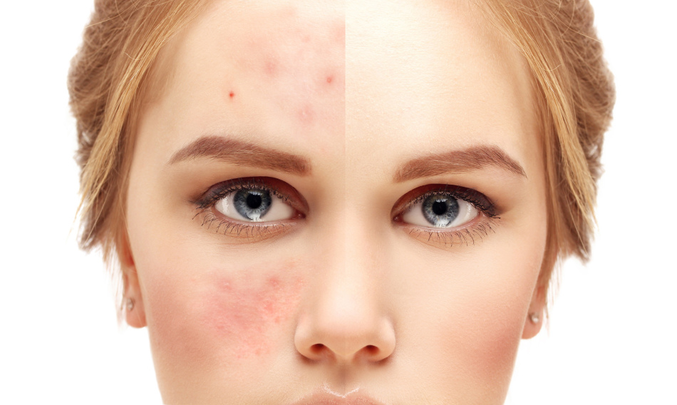 Iodine from acne on the face: before and after
