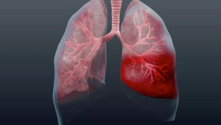 Suhu tinggi selama pneumonia