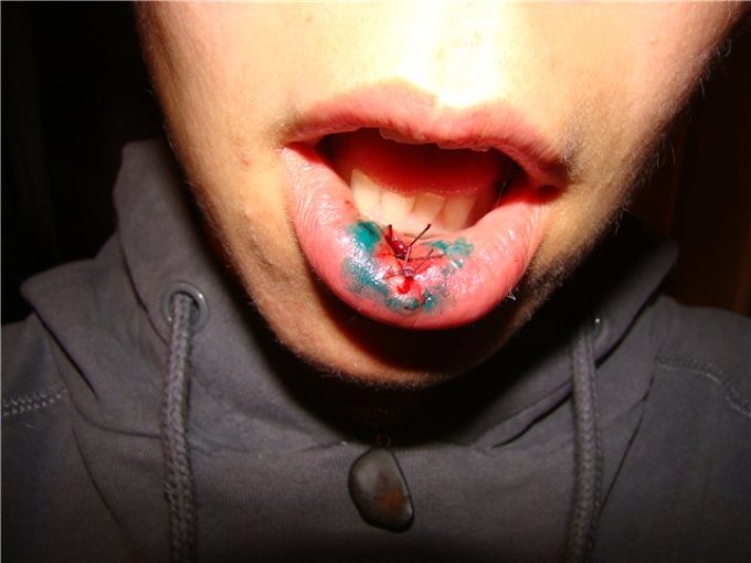 The child bit his lip, tongue or cheek very much to blood: what to do, how to help?