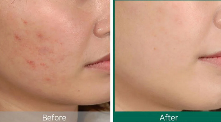 Le métronidazole aide à l'acné