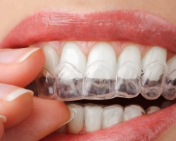 Hogyan erősítsük meg az ínyt, ha a fogak megdöbbentő periodontális betegséggel, ínygyulladással, periodontitissel? Az első fog megdöbbentő, hogyan kell erősíteni? A fogrugkolók a csapás után, hogyan kell erősíteni?