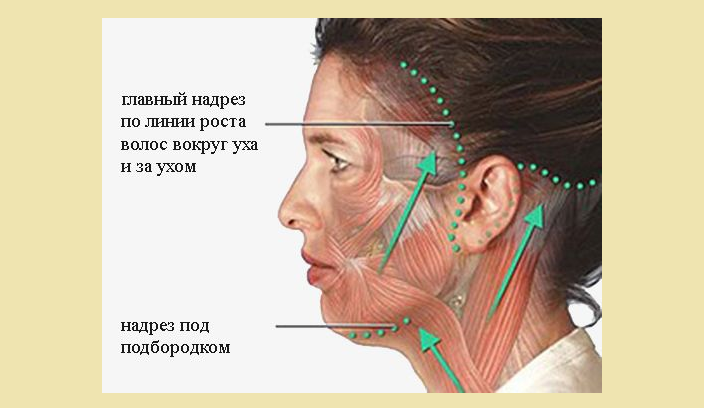 Процедура традиционной ритидэктомии кожи лица
