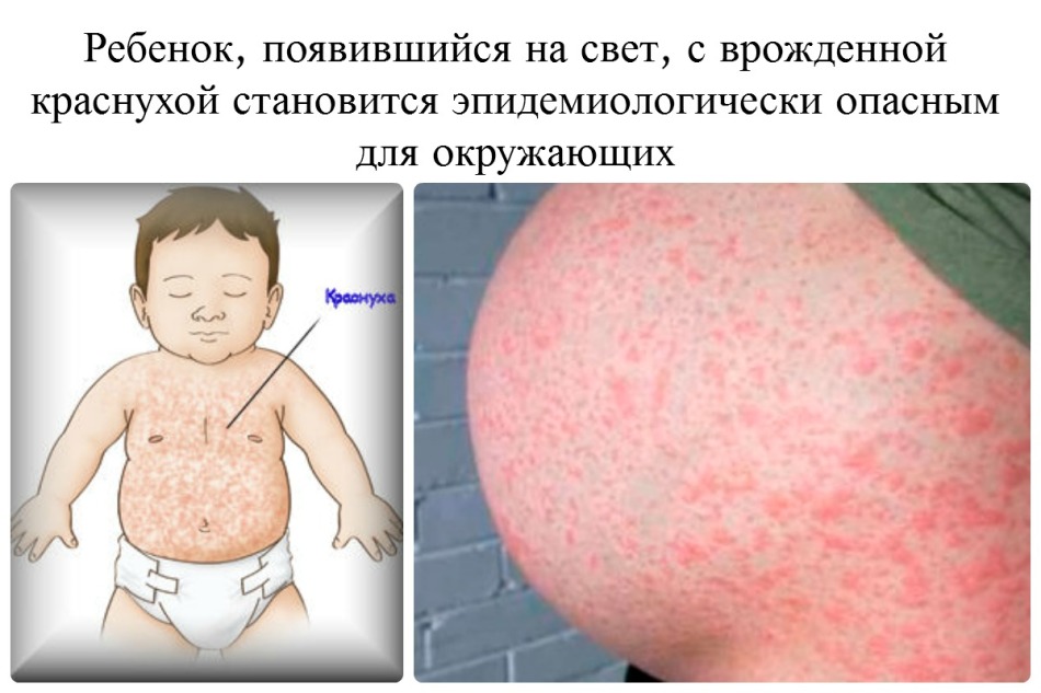 The consequences of rubella during pregnancy can be very serious