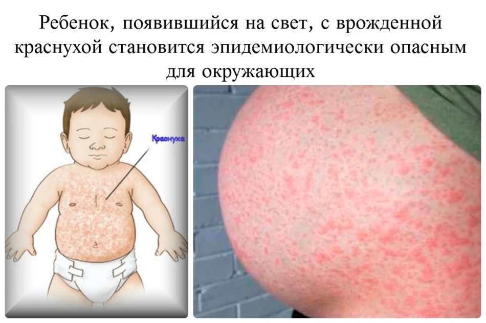 Последствия краснухи во время беременности могут быть очень серьезными