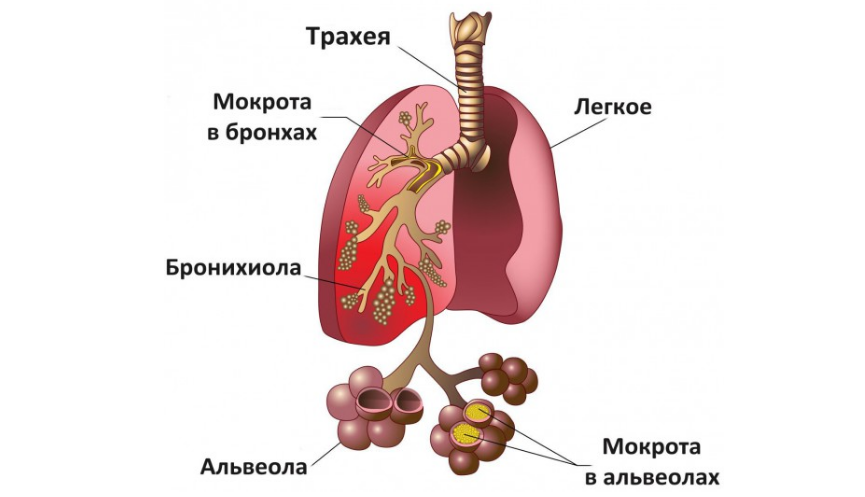 Mi a különbség a tüdőgyulladás és a tüdőgyulladás, a bronchitis között?