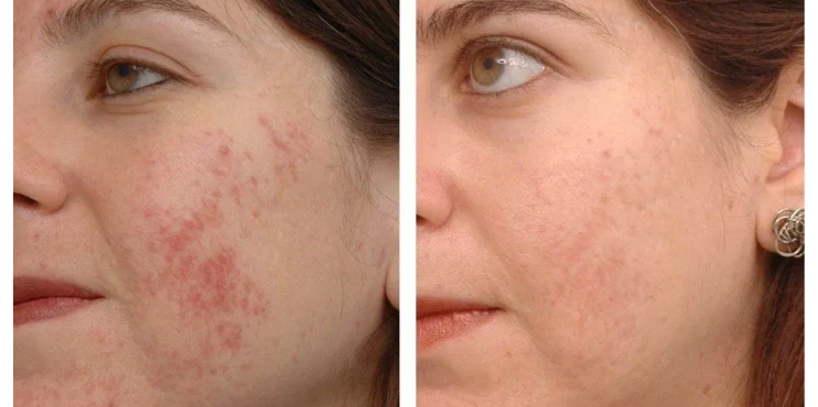 Facial skin photography - photo before and after