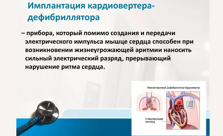 Medicinski samodejni implantabilni kardiover defibrilator (ICD)