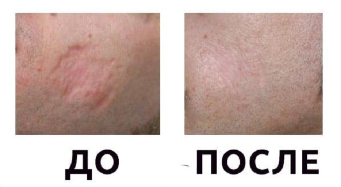 Treatment of scars from a burn: before and after