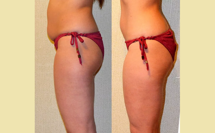 Результат после баночного массажа: фото до и после