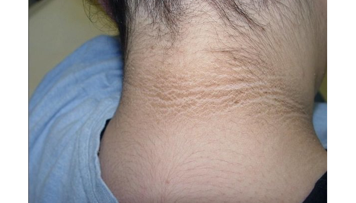 Black acanthosis - paranoplastic syndrome