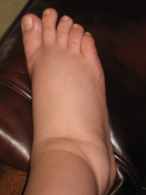 Swelling of the foot photo