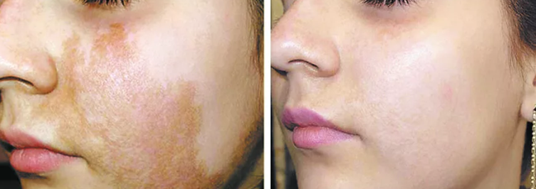 الأقنعة ، الإجراءات التجميلية باستخدام مساعدة ليزر من البقع على الوجه