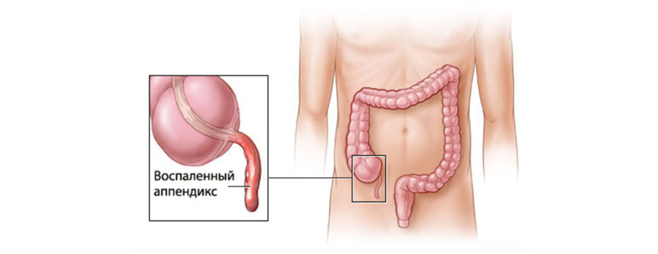 Krónikus appendicitis