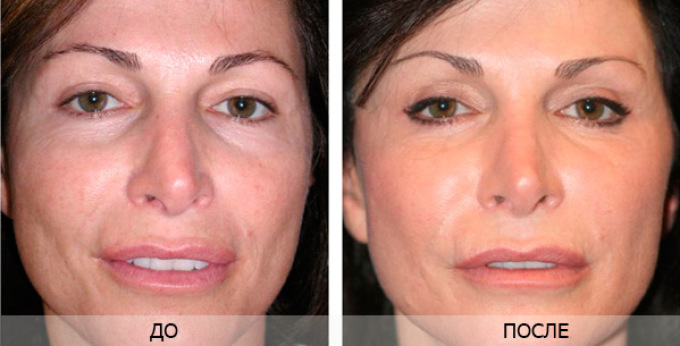 Piling helps to rejuvenate the skin of the face