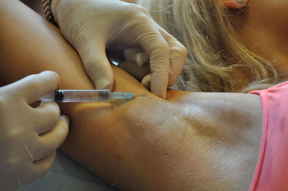 Pengobatan hiperhidrosis ketiak oleh Botox