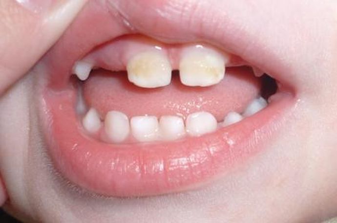 Otroška denticija