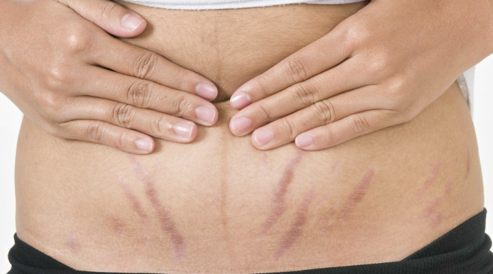 Mummy - an effective tool for stretch marks