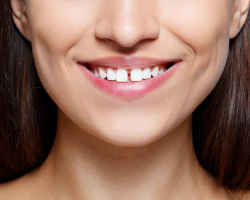 الفجوة بين الأسنان الأمامية: علامات إيجابية ، قيمة سالبة