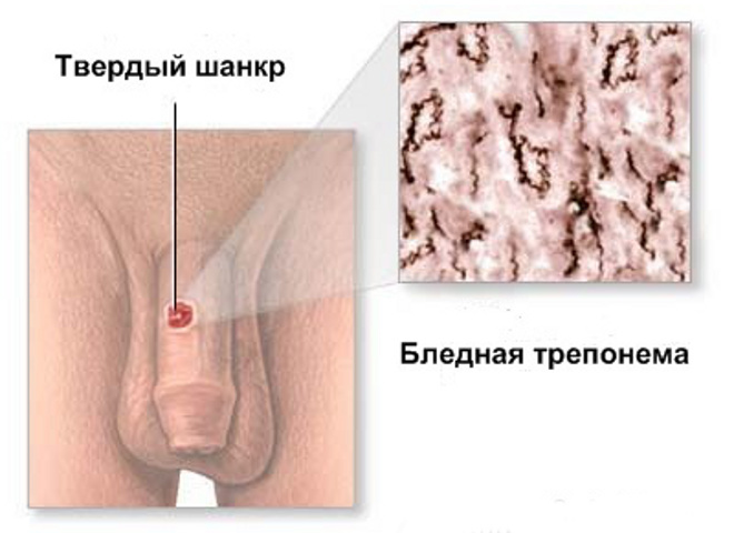 Как выглядит шанкр при сифилисе