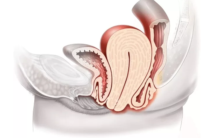 Prolapso uterino de 2 grados