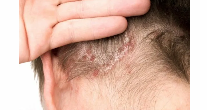 Seborrheic dermatitis - A fej hátulján vörös foltok jelentek meg a haj alatt, és lepattannak