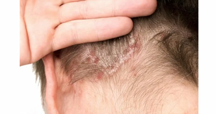 Seborrheic dermatit - På baksidan av huvudet dök röda fläckar upp under håret och skalar av