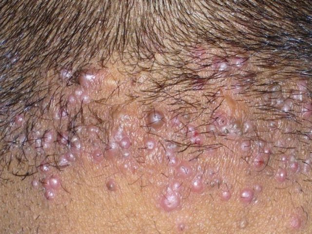 Acne on the head, nape, in the hair of men and women: causes, treatment, prevention. Treatment of acne on the head with folk methods, medications and shampoos