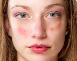 What to do if the red cheeks itch, dry, peel off in the cold, after cosmetics? Creams, masks, scrubs from peeling and redness of cheeks