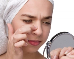 Acne on the nose: causes in women and men. How to get rid of acne on the nose in one day?