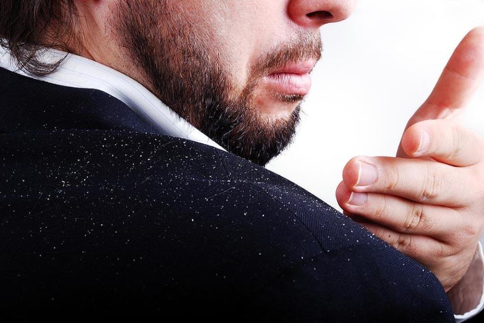 Dandruff in men