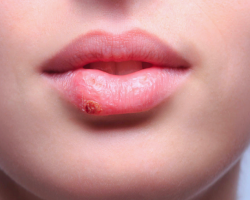 What is the cold, herpes on the lip, nose, language of the girl, women, men: omen, what does this mean?