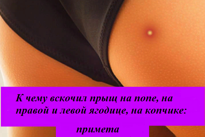 Why the pimple jumped on the priest, on the right and left buttocks, on the tailbone: a sign for girls, women and men. Interpretation of signs in size acne, by day of the week
