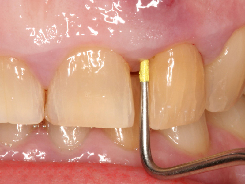Purulent fistula on the gums